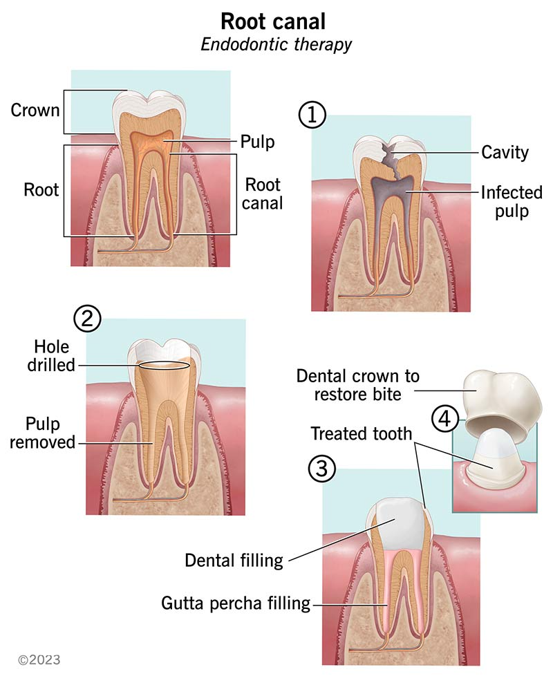 Root Canal: What It Treats, Procedure & Recovery
